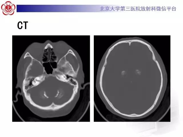 【病例】Fahr病1例CT影像表现与鉴别