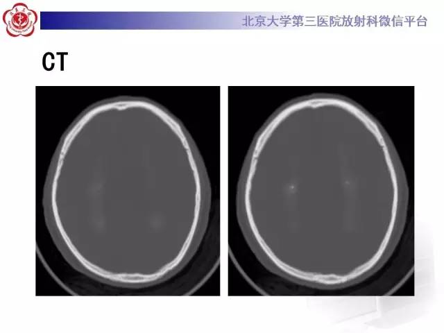 【病例】Fahr病1例CT影像表现与鉴别