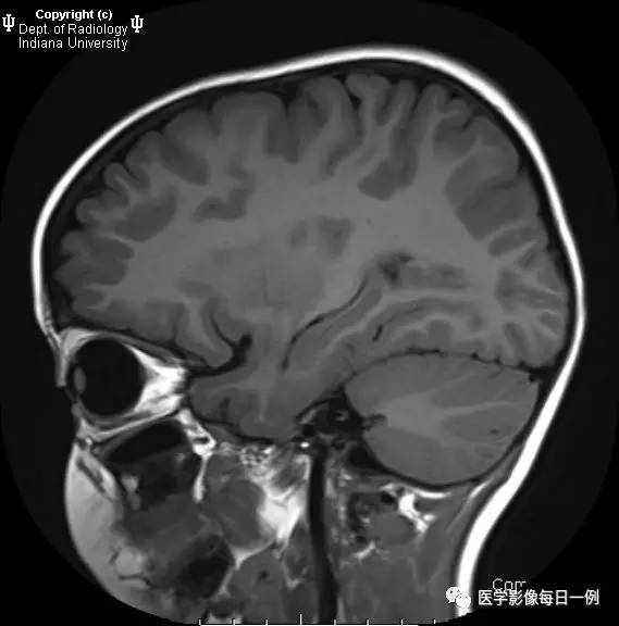 【病例】Chiari畸形I型1例MR