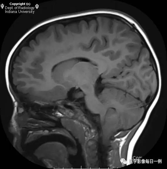 【病例】Chiari畸形I型1例MR