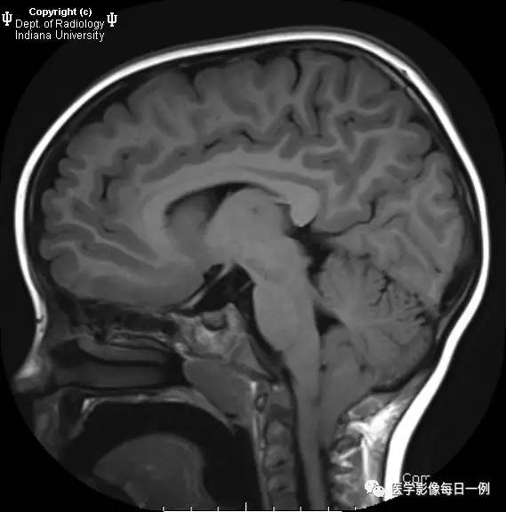 【病例】Chiari畸形I型1例MR