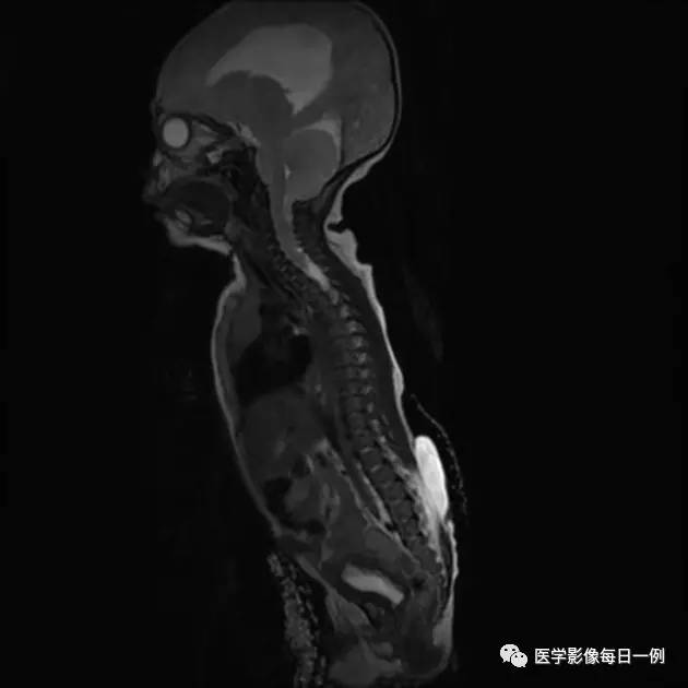 【病例】Chiari畸形I型1例MR