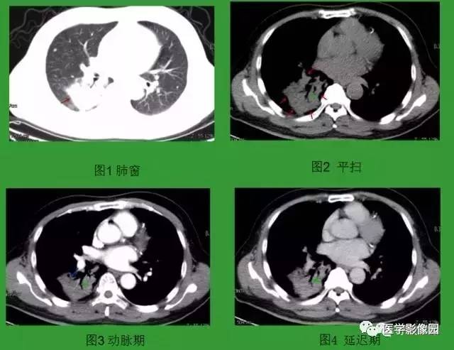 肺隐球菌影像剖析 肺隐球菌影像剖析