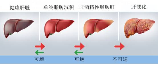 多图读懂肝硬化的影像学表现 多图读懂肝硬化的影像学表现