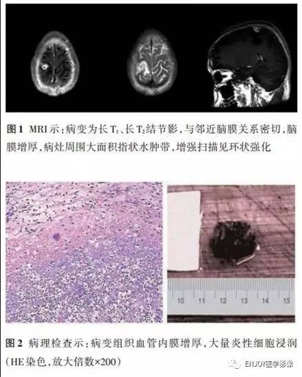 手把手教你会读片:梅毒树胶样肿 手把手教你会读片:梅毒树胶样肿