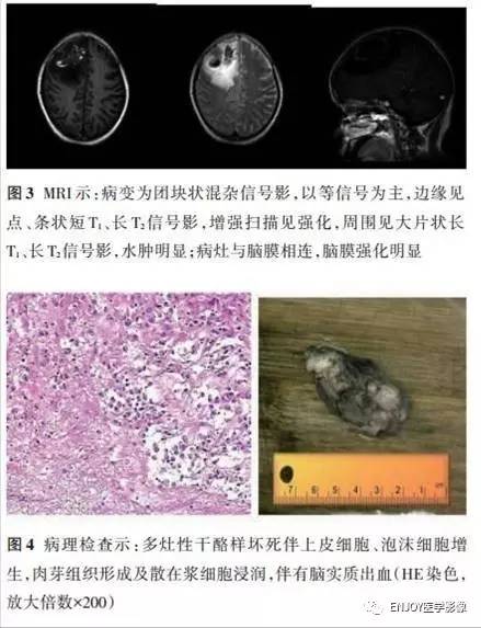 手把手教你会读片:梅毒树胶样肿 手把手教你会读片:梅毒树胶样肿