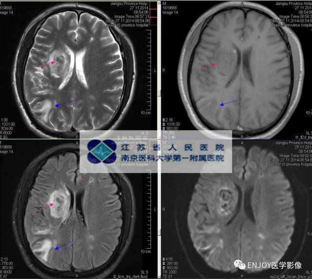 手把手教你会读片:梅毒树胶样肿 手把手教你会读片:梅毒树胶样肿