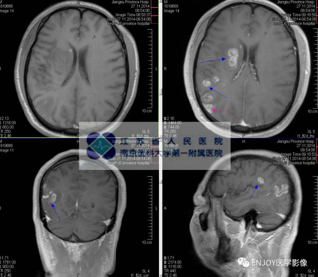 手把手教你会读片:梅毒树胶样肿 手把手教你会读片:梅毒树胶样肿