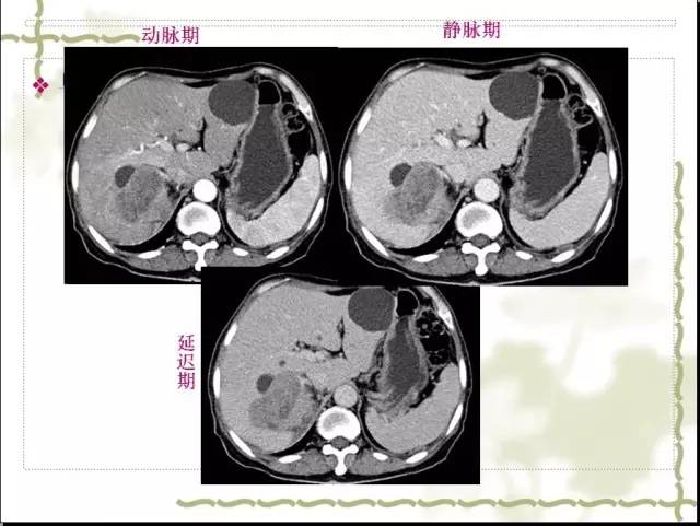 【病例】右肾肉瘤样癌1例CT影像表现