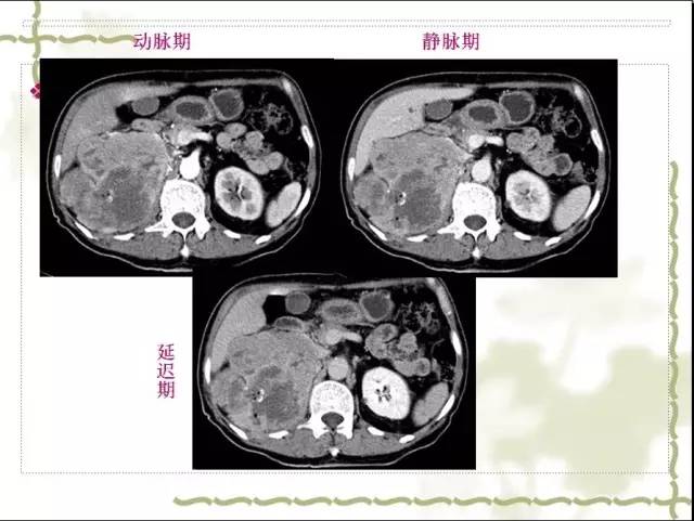 【病例】右肾肉瘤样癌1例CT影像表现 【病例】右肾肉瘤样癌1例CT影像表现
