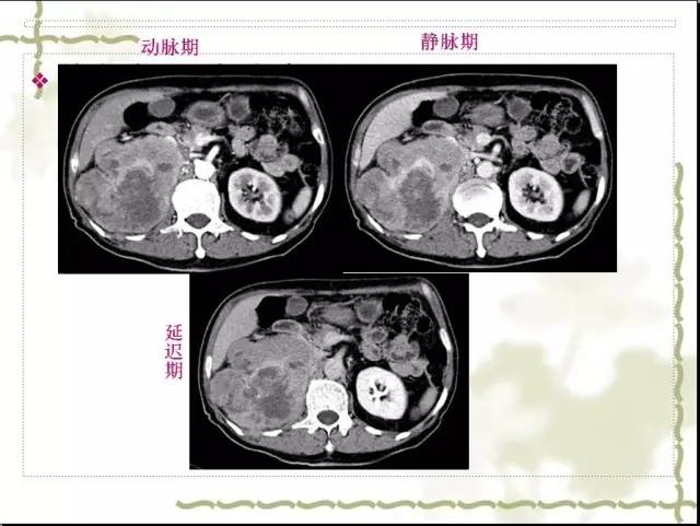 【病例】右肾肉瘤样癌1例CT影像表现 【病例】右肾肉瘤样癌1例CT影像表现