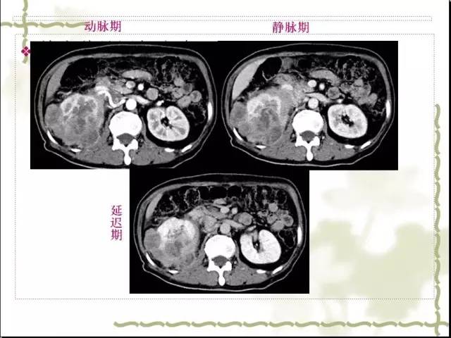 【病例】右肾肉瘤样癌1例CT影像表现 【病例】右肾肉瘤样癌1例CT影像表现