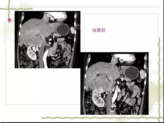 【病例】右肾肉瘤样癌1例CT影像表现 【病例】右肾肉瘤样癌1例CT影像表现