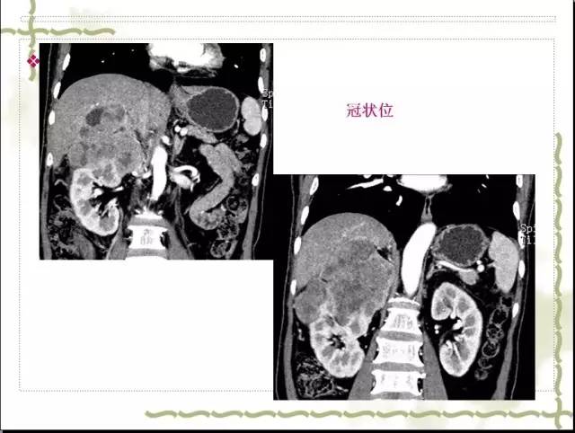 【病例】右肾肉瘤样癌1例CT影像表现 【病例】右肾肉瘤样癌1例CT影像表现