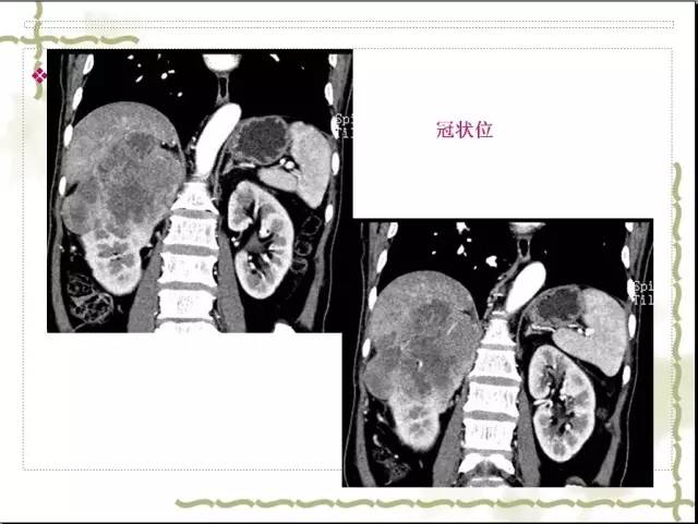 【病例】右肾肉瘤样癌1例CT影像表现 【病例】右肾肉瘤样癌1例CT影像表现