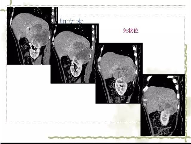 【病例】右肾肉瘤样癌1例CT影像表现 【病例】右肾肉瘤样癌1例CT影像表现