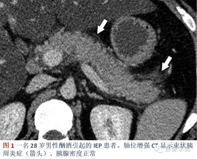 急性胰腺炎分类分级分期影像学表现 急性胰腺炎分类分级分期影像学表现