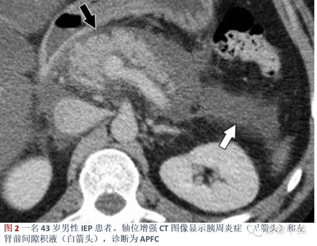急性胰腺炎分类分级分期影像学表现