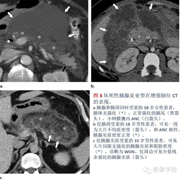 急性胰腺炎分类分级分期影像学表现 急性胰腺炎分类分级分期影像学表现