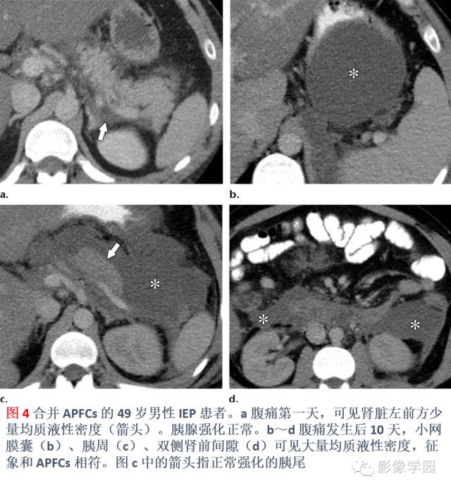 急性胰腺炎分类分级分期影像学表现 急性胰腺炎分类分级分期影像学表现