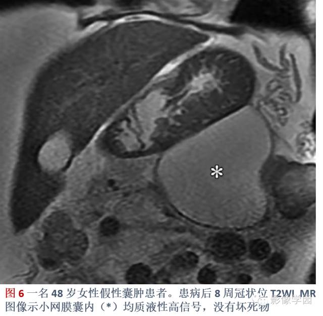 急性胰腺炎分类分级分期影像学表现 急性胰腺炎分类分级分期影像学表现