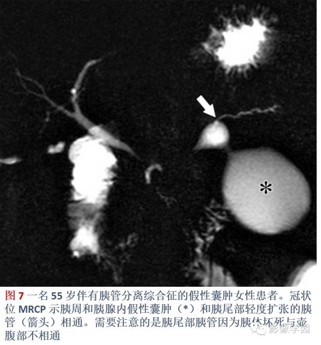 急性胰腺炎分类分级分期影像学表现 急性胰腺炎分类分级分期影像学表现