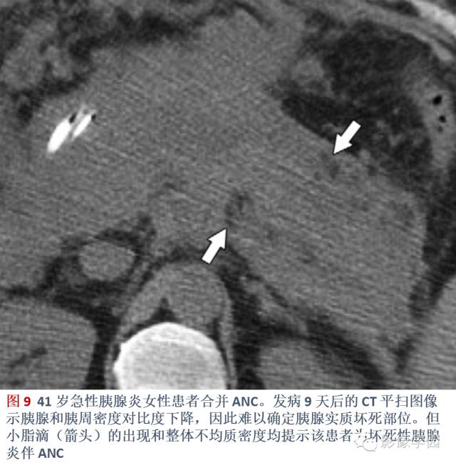 急性胰腺炎分类分级分期影像学表现 急性胰腺炎分类分级分期影像学表现