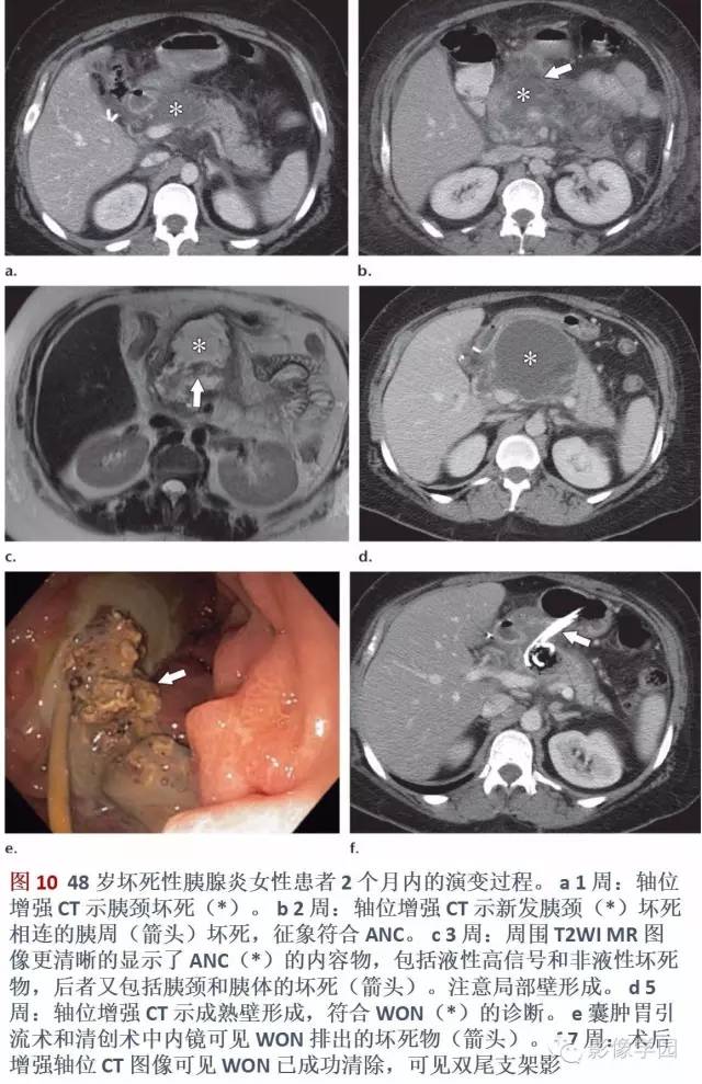 急性胰腺炎分类分级分期影像学表现