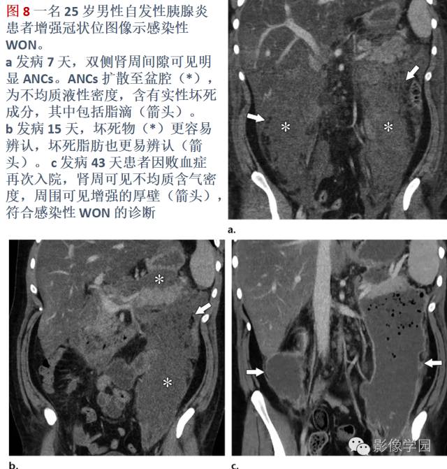 急性胰腺炎分类分级分期影像学表现 急性胰腺炎分类分级分期影像学表现