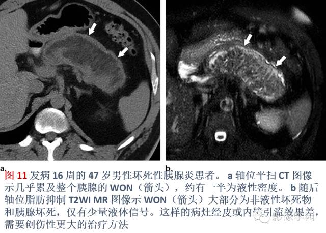急性胰腺炎分类分级分期影像学表现 急性胰腺炎分类分级分期影像学表现