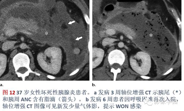急性胰腺炎分类分级分期影像学表现 急性胰腺炎分类分级分期影像学表现