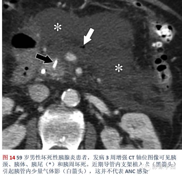 急性胰腺炎分类分级分期影像学表现 急性胰腺炎分类分级分期影像学表现