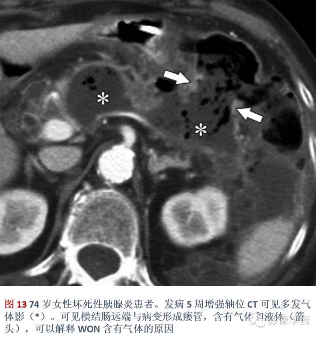 急性胰腺炎分类分级分期影像学表现 急性胰腺炎分类分级分期影像学表现
