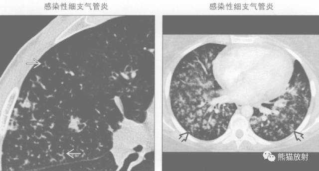【书摘】“树芽征”的鉴别诊断