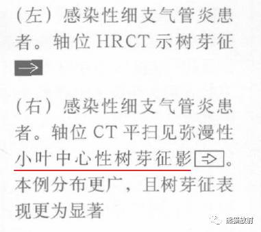 【书摘】“树芽征”的鉴别诊断