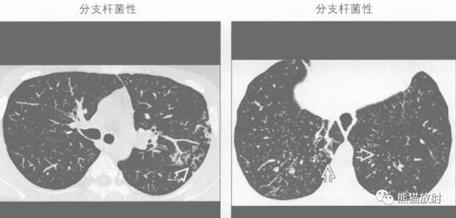 【书摘】“树芽征”的鉴别诊断