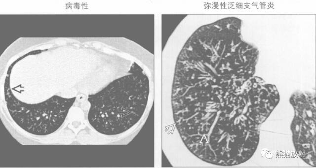 【书摘】“树芽征”的鉴别诊断