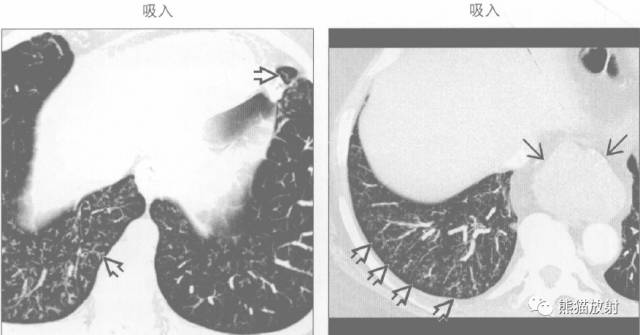 【书摘】“树芽征”的鉴别诊断