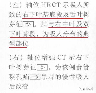 【书摘】“树芽征”的鉴别诊断