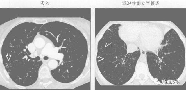 【书摘】“树芽征”的鉴别诊断