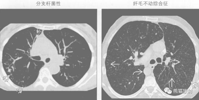 【书摘】“树芽征”的鉴别诊断