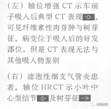 【书摘】“树芽征”的鉴别诊断