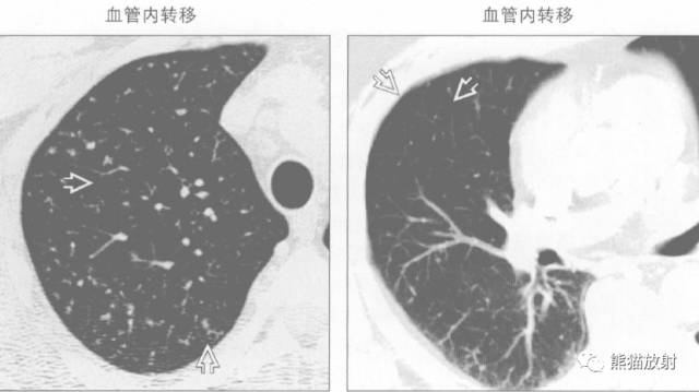 【书摘】“树芽征”的鉴别诊断