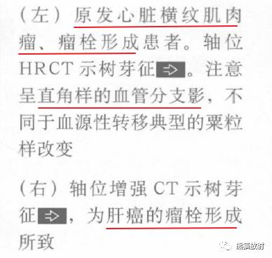 【书摘】“树芽征”的鉴别诊断