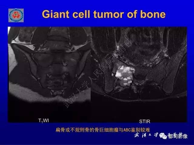 【PPT】含液-液平面骨病变影像诊断