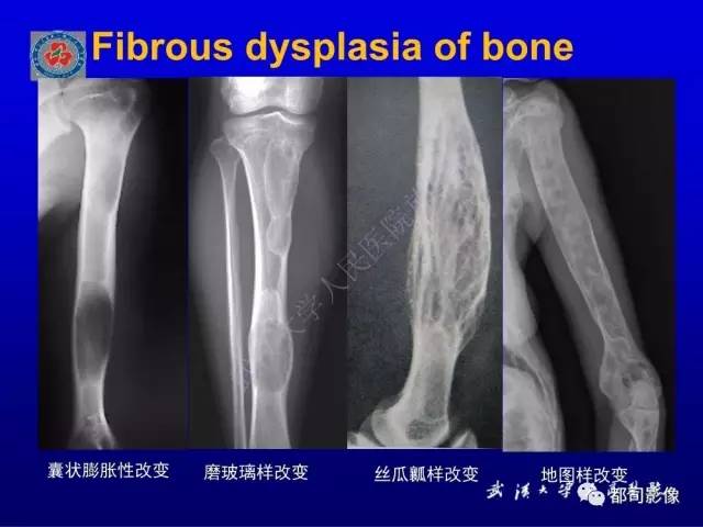 【PPT】含液-液平面骨病变影像诊断
