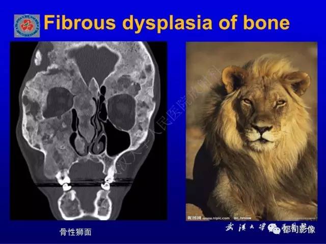 【PPT】含液-液平面骨病变影像诊断