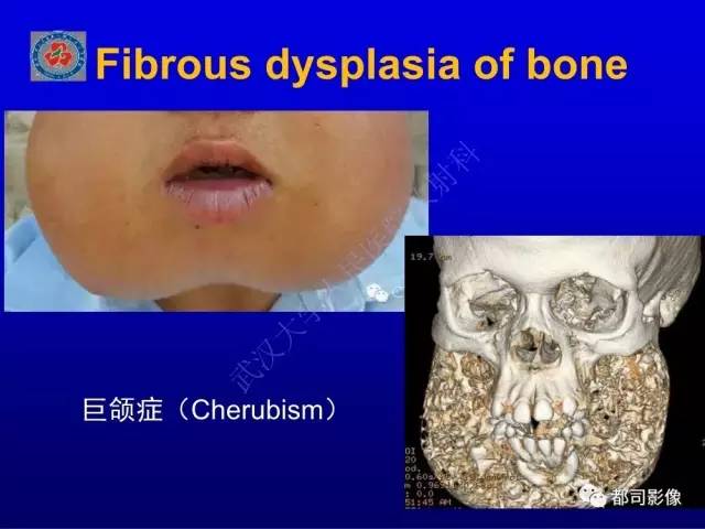 【PPT】含液-液平面骨病变影像诊断