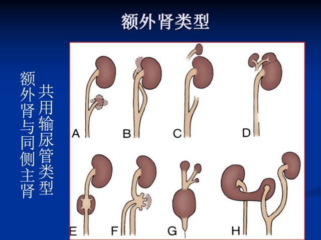 【PPT】泌尿系先天性发育异常的CT诊断