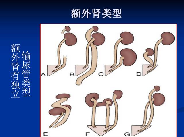 【PPT】泌尿系先天性发育异常的CT诊断